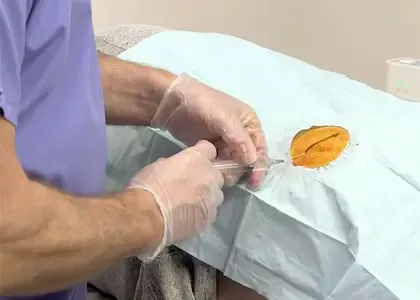 Кодирование от алкоголизма вшивание